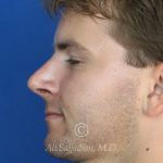 after rhinoplasty left side view of male patient 21640