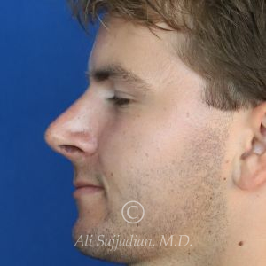 after rhinoplasty left side view of male patient 21640