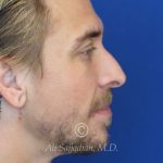 before rhinoplasty right side view of patient 21698