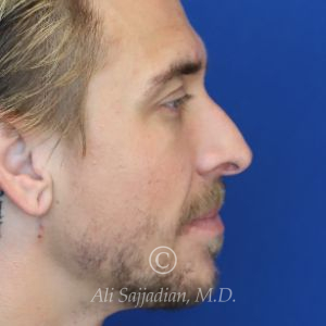 before rhinoplasty right side view of patient 21698