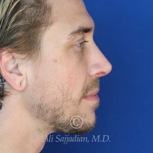 after rhinoplasty right side view of patient 21698