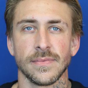 before rhinoplasty front view of patient 21698
