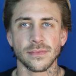 after rhinoplasty front view of patient 21698