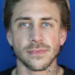 after rhinoplasty front view of patient 21698