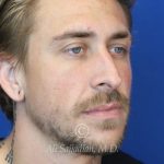 before rhinoplasty right angle view of patient 21698