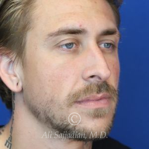 before rhinoplasty right angle view of patient 21698