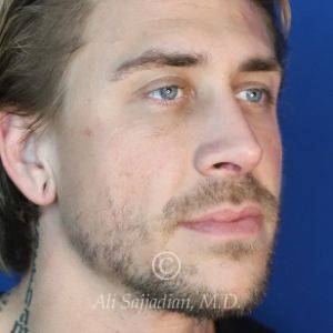after rhinoplasty right angle view of patient 21698