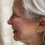 before rhinoplasty left side view of female patient 21735