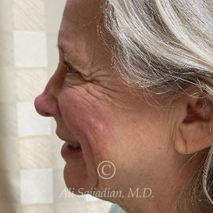 before rhinoplasty left side view of female patient 21735