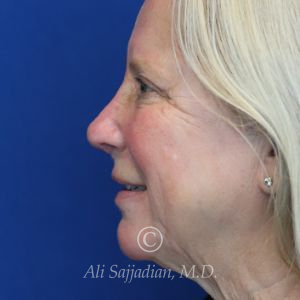 after rhinoplasty left side view of female patient 21735