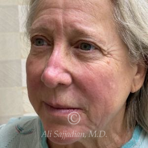 before rhinoplasty left angle view of female patient 21735