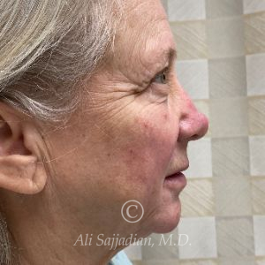 before rhinoplasty right side view of female patient 21735