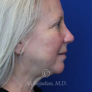 after rhinoplasty right side view of female patient 21735