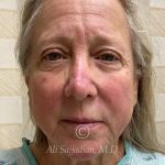 before rhinoplasty front view of female patient 21735