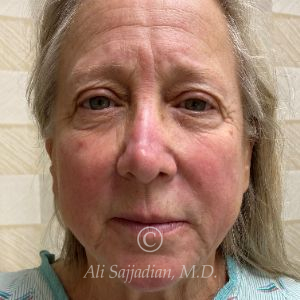 before rhinoplasty front view of female patient 21735