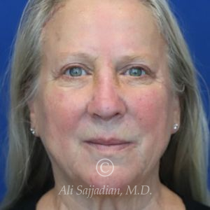 after rhinoplasty front view of female patient 21735