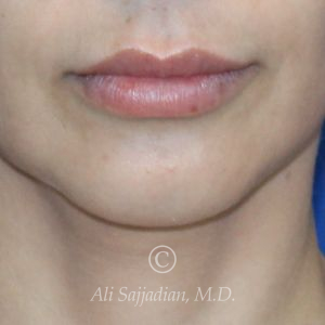 before lip lift front view of female patient 22064