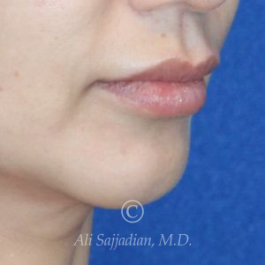 before lip lift right angle view of female patient 22064