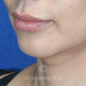 before lip lift left angle view of female patient 22064