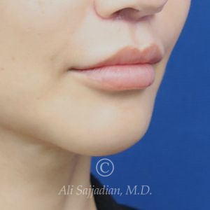 after lip lift right angle view of female patient 22064