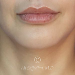 after lip lift front view of female patient 22064