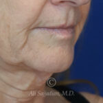 before lip lift right angle view of female patient 22075