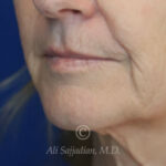 after lip lift left angle view of female patient 22075