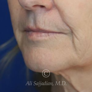 after lip lift left angle view of female patient 22075