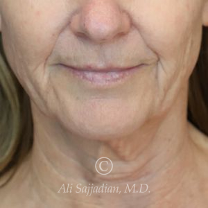 before lip lift front view of female patient 22075