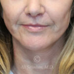 after lip lift front view of female patient 22075