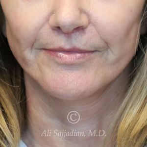 after lip lift front view of female patient 22075
