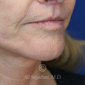 before lip lift right angle view of female patient 22075