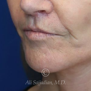 before lip lift left angle view of female patient 22075