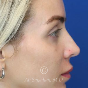 before lip lift right side view of full female patient 22082