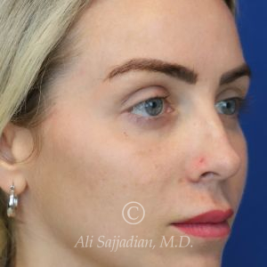 before lip lift right angle view of full female patient 22082