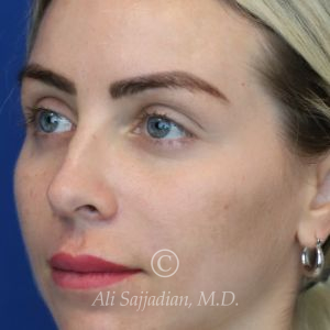 before lip lift left angle view of full female patient 22082