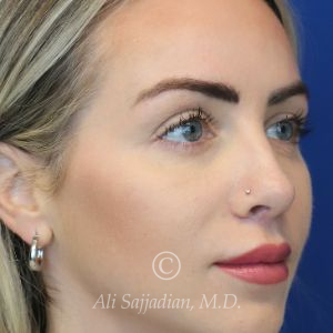 after lip lift right angle view of full female patient 22082