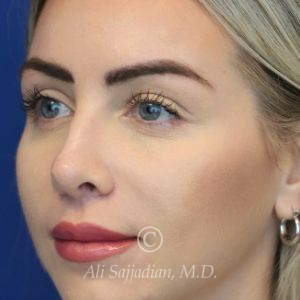 after lip lift left angle view of full female patient 22082