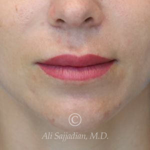 before lip lift front view of female patient 22082