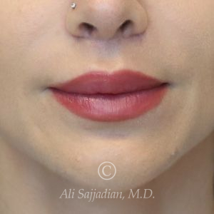 after lip lift front view of female patient 22082