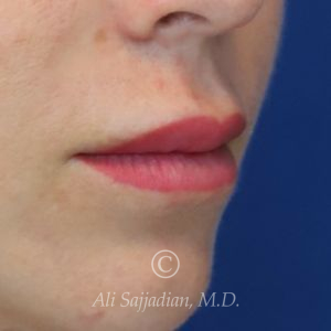 before lip lift right angle view of female patient 22082