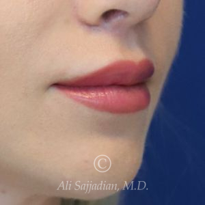 after lip lift right angle view of female patient 22082