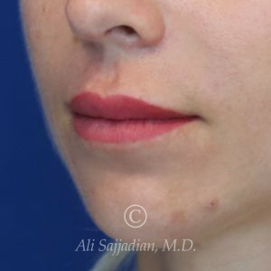 before lip lift left angle view of female patient 22082