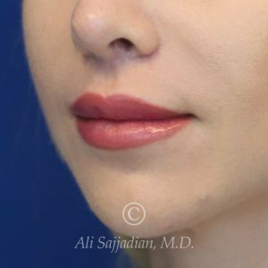 after lip lift left angle view of female patient 22082