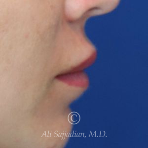 before lip lift right side view of female patient 22082