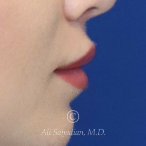 after lip lift right side view of female patient 22082